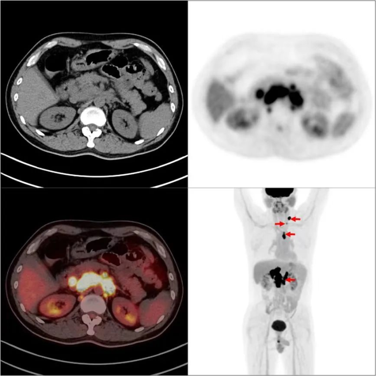 精准追踪，PET/CT让“千面肿瘤”无所遁形